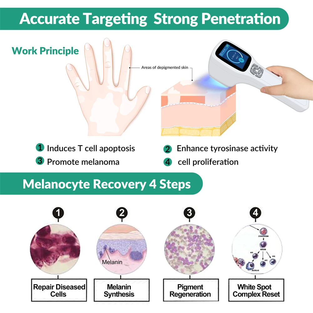 Zjkc Uvb Lamp Voor Vitiligo Psoriasis Eczeem 308nm Excimer Fototherapie Apparaat Voor Pigmenthuid Ziekte Gezondheidszorg