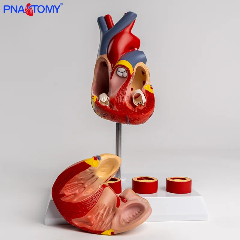Heart Thrombus Model Anatomically Dissectable Teaching Simulation Natural-sized Heart Thrombus Vascular Model