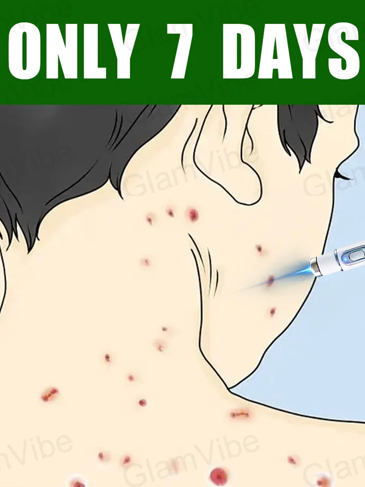 2025 Neues Upgrade Blue Laser lösen Warzenwerkzeug