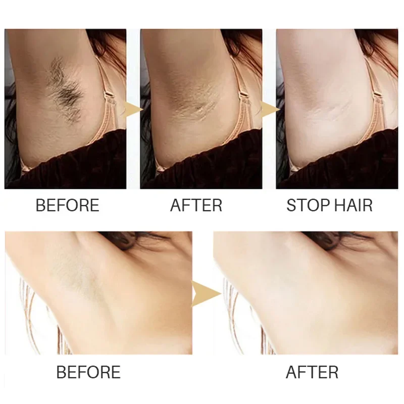 Hair Remover Cream Inhibition Hair Growth Permanant Removal Inhibitor Beard Bikini Intimate Legs Body Armpit Painless Remover