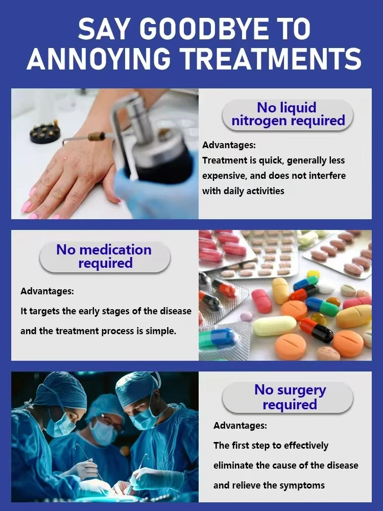 The Latest Generation Blue Light Laser Pen for Wart Removal Has Improved Its Effectiveness By 50%, Quickly Eliminating Warts