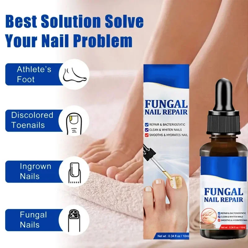 

Fungal Nail Removal 10ML Fungal Nail Treatment Oil Foot Repair Essence Toe Nail Fungus Removal Gel Anti Infection Cream