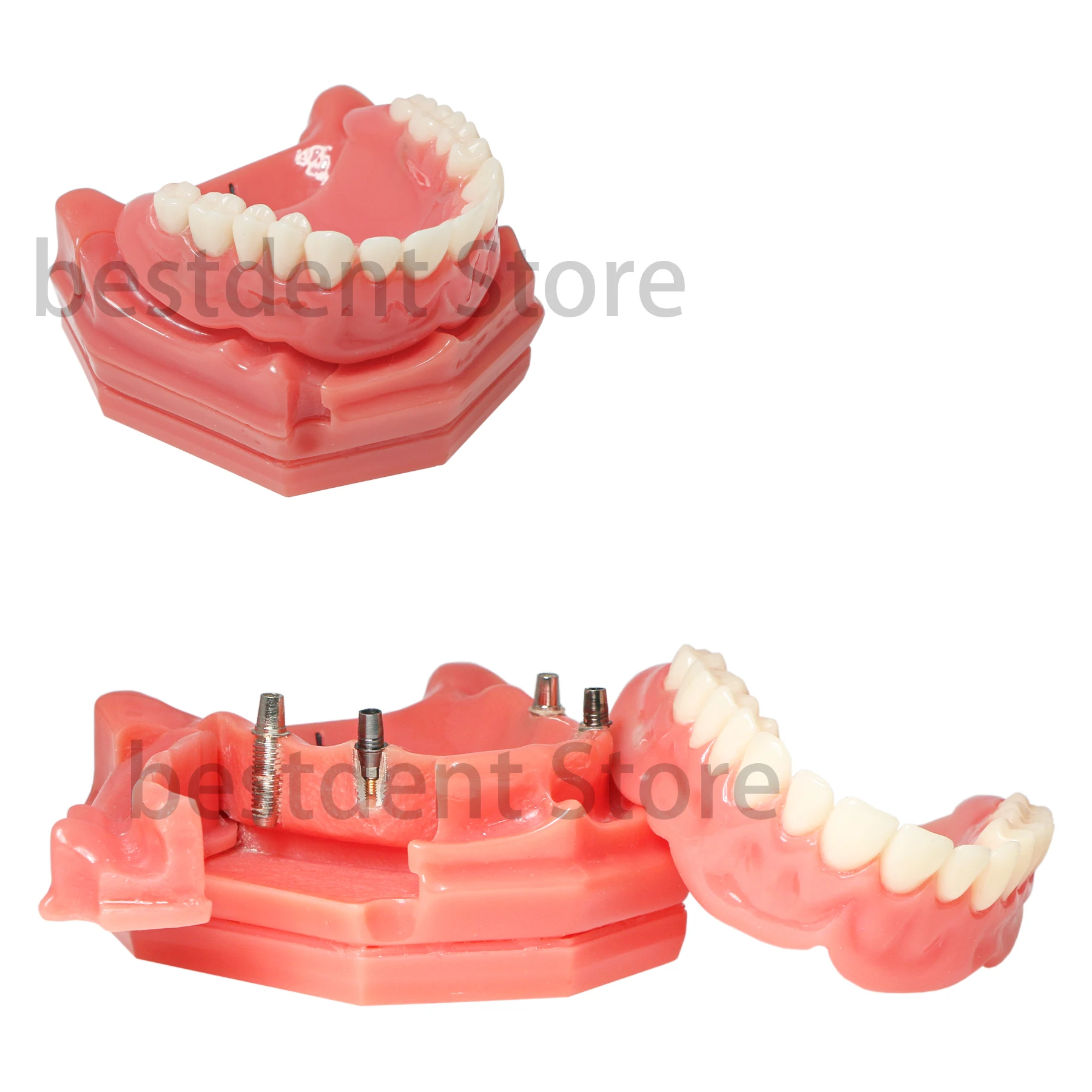 Dental Implant Tooth Model Demonstration Semi-Oral Movable Overdenture Tooth Mold Covering Model M6001A