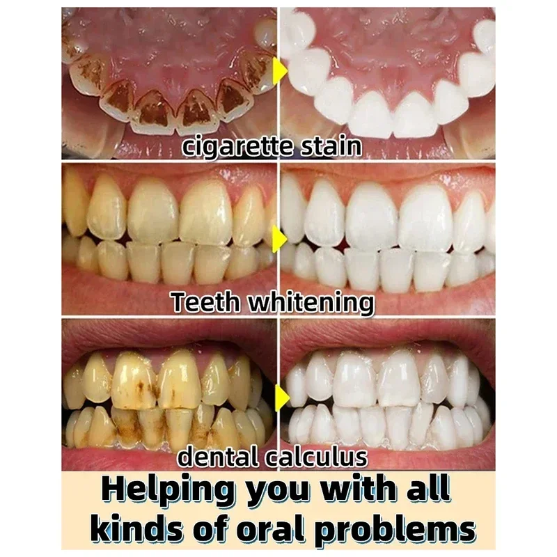 Fourni ver calcul dentaire filtré, élimination des odeurs de la bouche des dents, mauvaise prévention temporaire de la parodontite