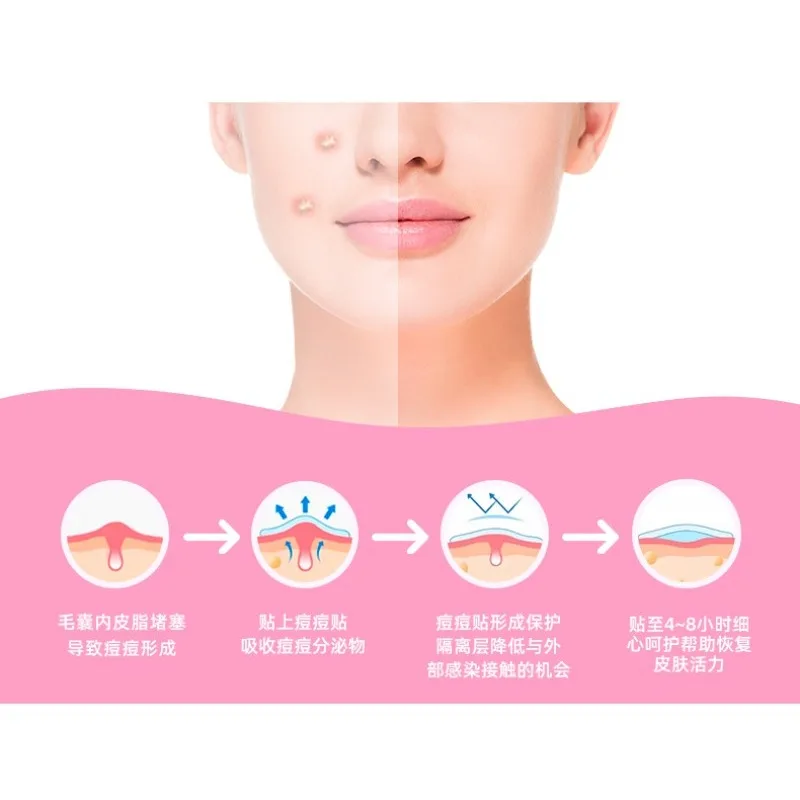 แผ่นแปะรักษาสิวแบบคอลลอยด์ แผ่นแปะซ่อมแซมรอยแผลเป็นจากสิว ลดเลือนและซ่อมแซมรอยแผลเป็นจากสิว แผ่นแปะกำจัดสิว อุปกรณ์ดูแลผิวหน้า