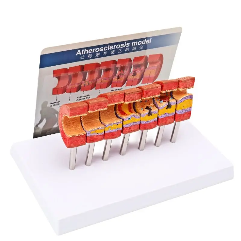 Human Medical Teaching Model Atherosclerosis Model Vascular Thromboembolism Model Arterial Vessel