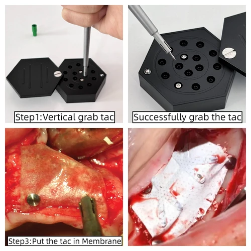 Imagen 2 del producto Kit de fijación de membrana de tachuela de hueso GBR Dental, caja de Pin de conductor de titanio, estabilización de fijación de aleación, clavo de cabeza plana de 3,75mm y 5mm