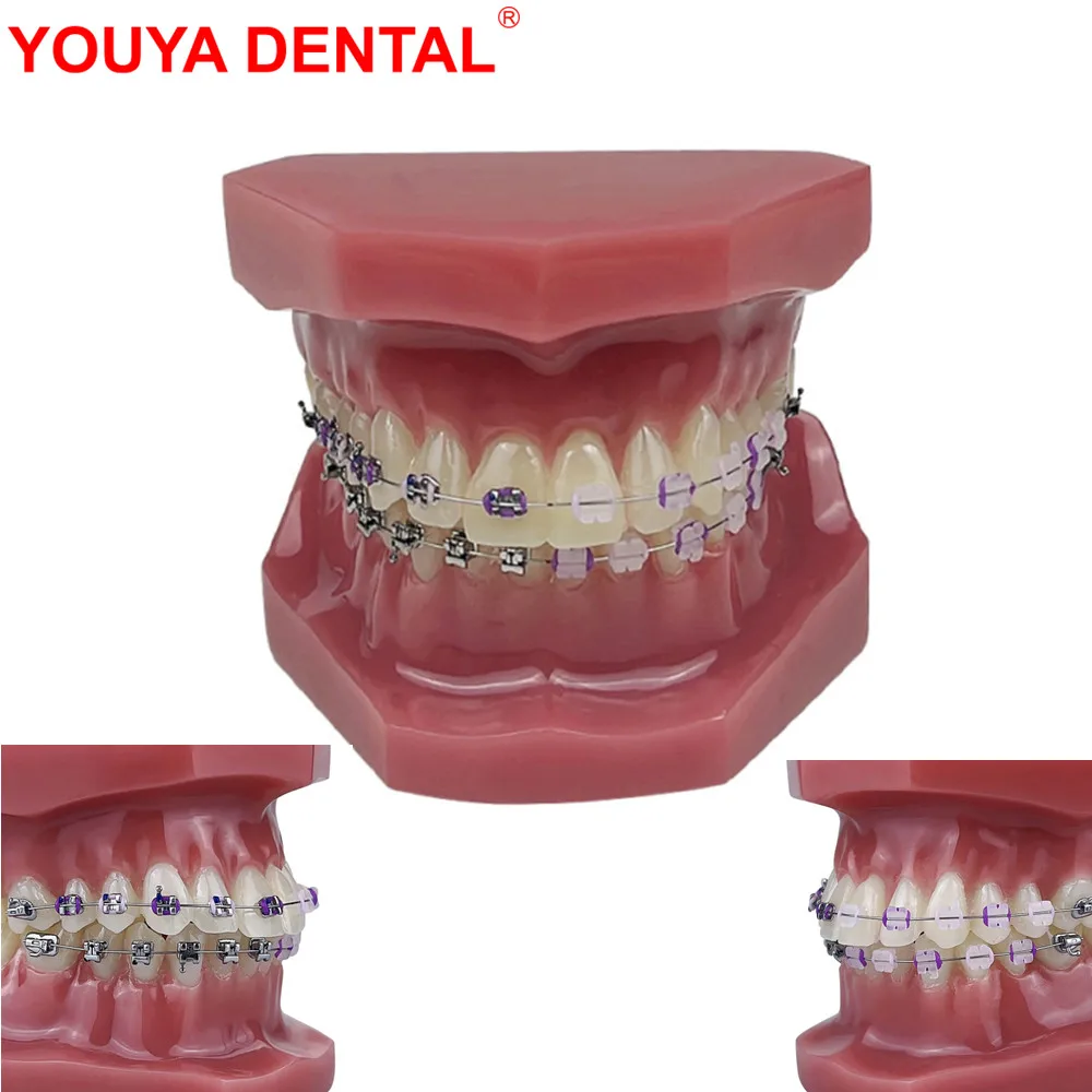 Orthodontic Dental Model Dentistry Treatment Orthodontic Teeth Model With Braces Bracket    For Teaching Studying Demo Education