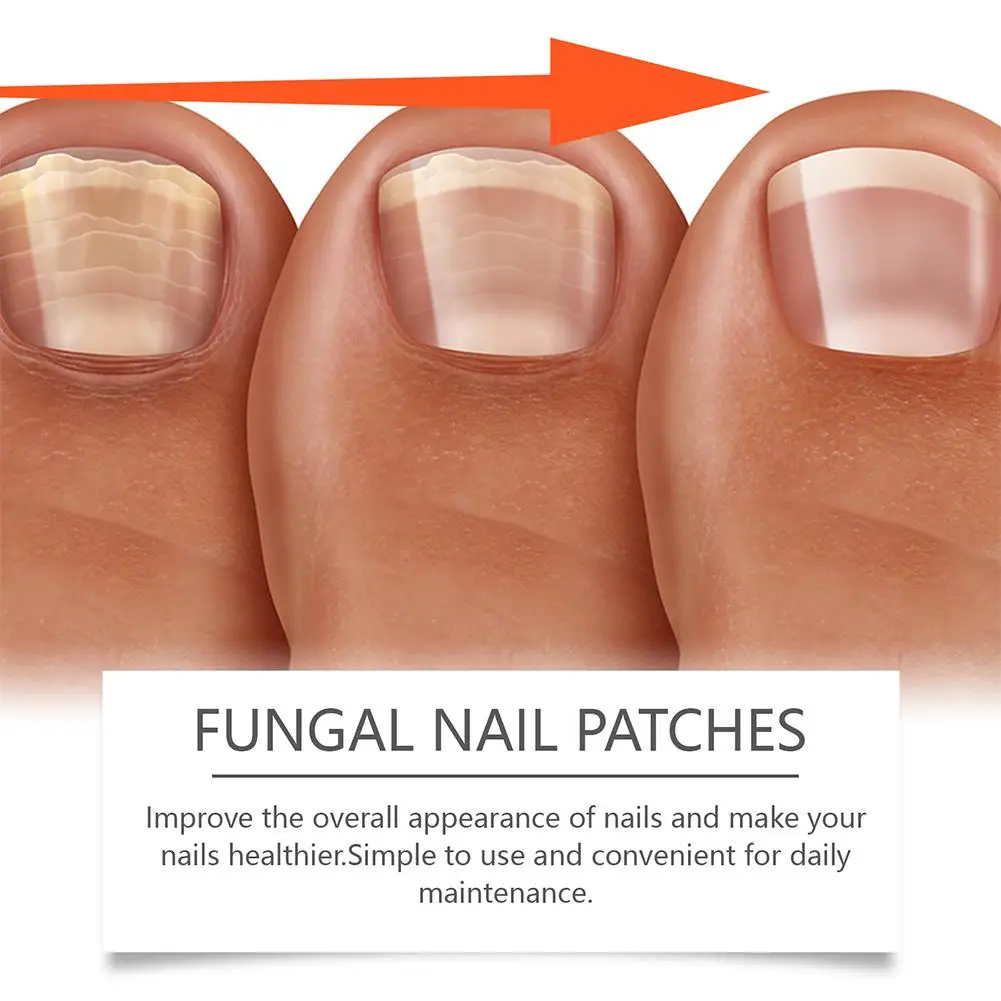 Fungus Nail Care Patch Convenient Fungus Nail Care Strips Gentle And Effective Nail Repair Clean And Easy To Use For Daily Care