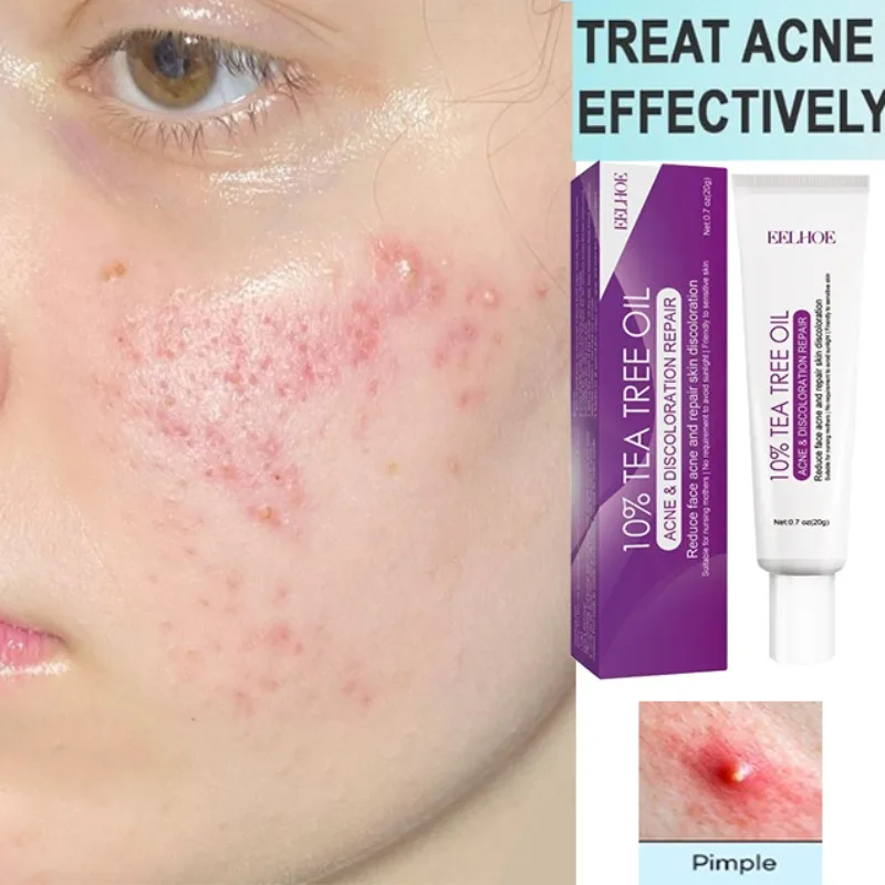 

Effective Acne Removal Comfortable Acne-removing Liquid Improve Acne Convenient Facial Repair Solution Skin Care Products Gentle