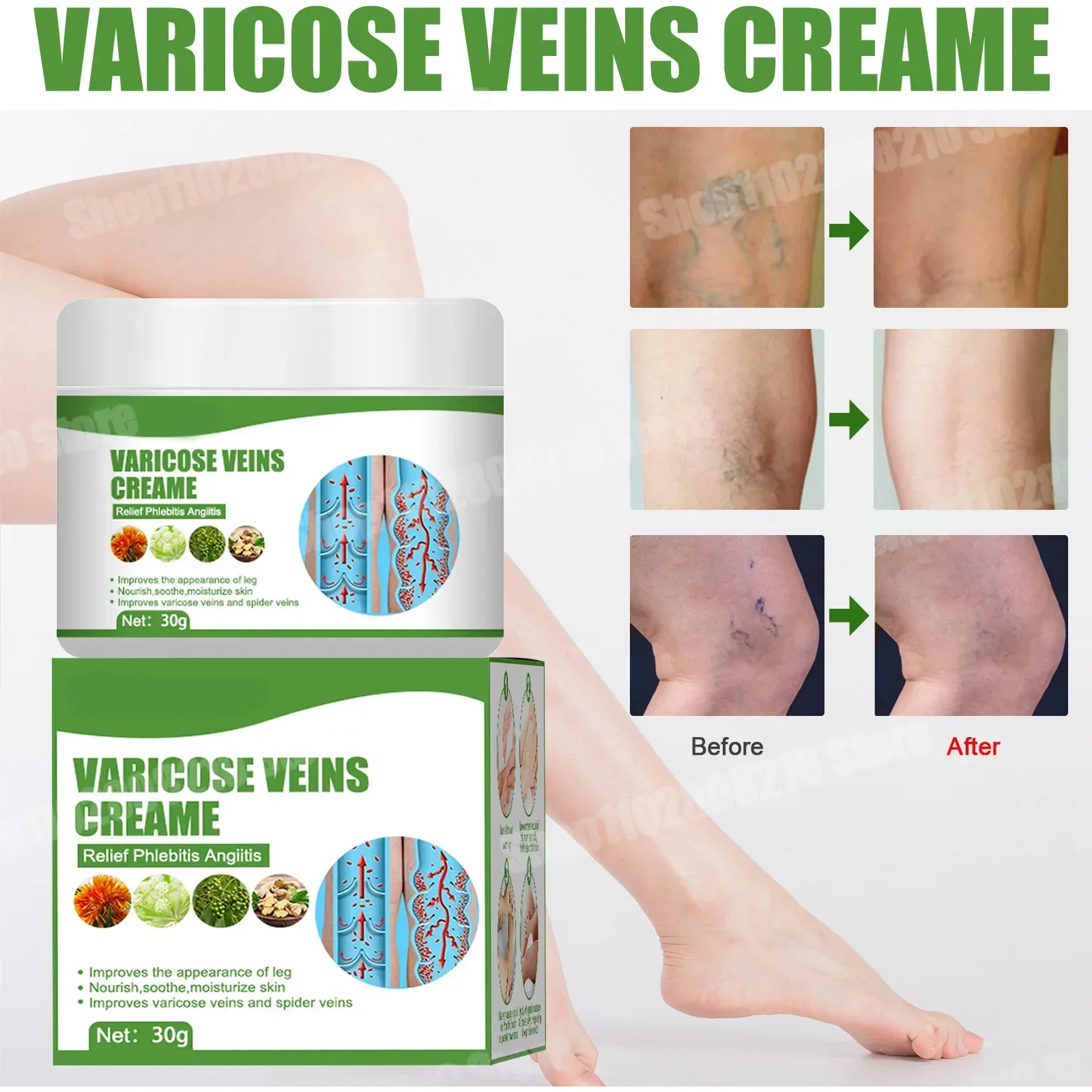 Creme de tratamento de veias varicosas, remove estrias vermelhas no sangue, varicocélula, vasculite, flebite, fortalece a saúde capilar