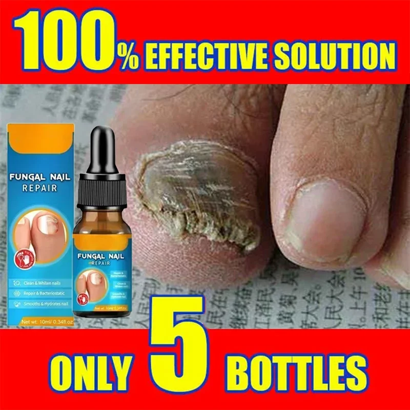 

Strong Nail Fungus Treatment Cream Nail Repair Nail fungus repair treatment Care