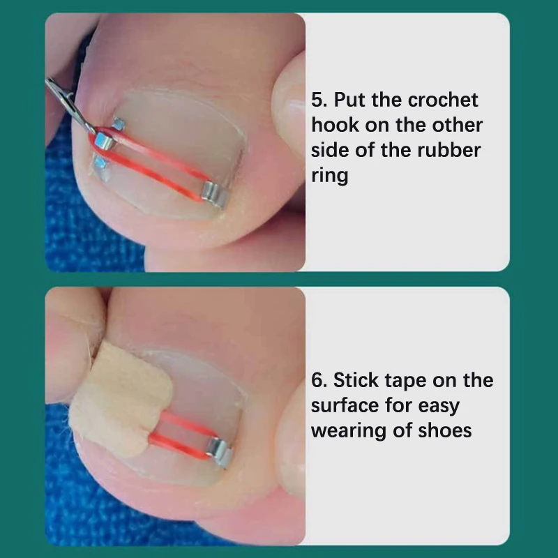 Ingrown Toenail Corrector Tools Pedicure Recover Embed Toe Nail Treatment Professional Ingrown Toenail Correction Foot Care Tool