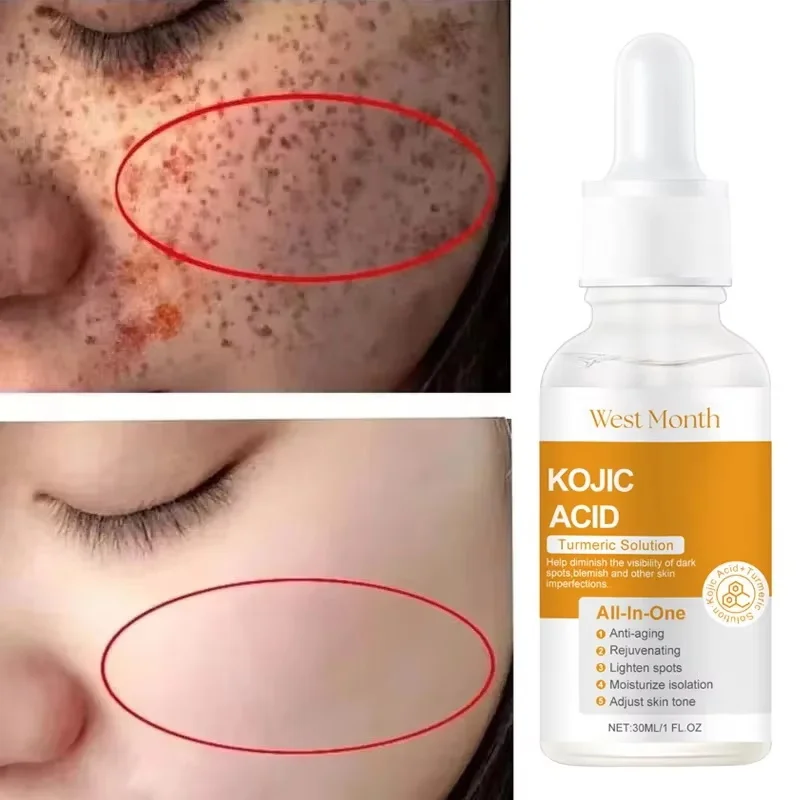 Kojic Acid Freckle Removing Whitening Essence Fade Pigmentation Melasma Dark Spots Corrector Repair Serum Korean Skin Care