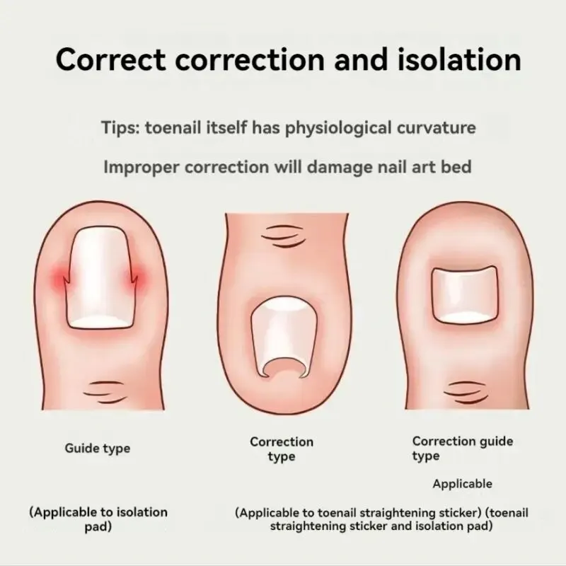 Ingrown Nail Correction C Shape Filler Spacer Patch Positive Nail Patch Nail Groove Pad Ingrown Nail Corrector Pedicure Tool