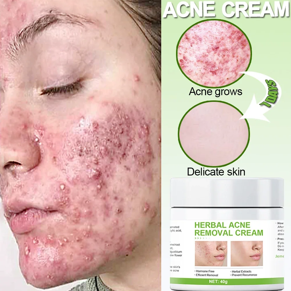 creamtreatment