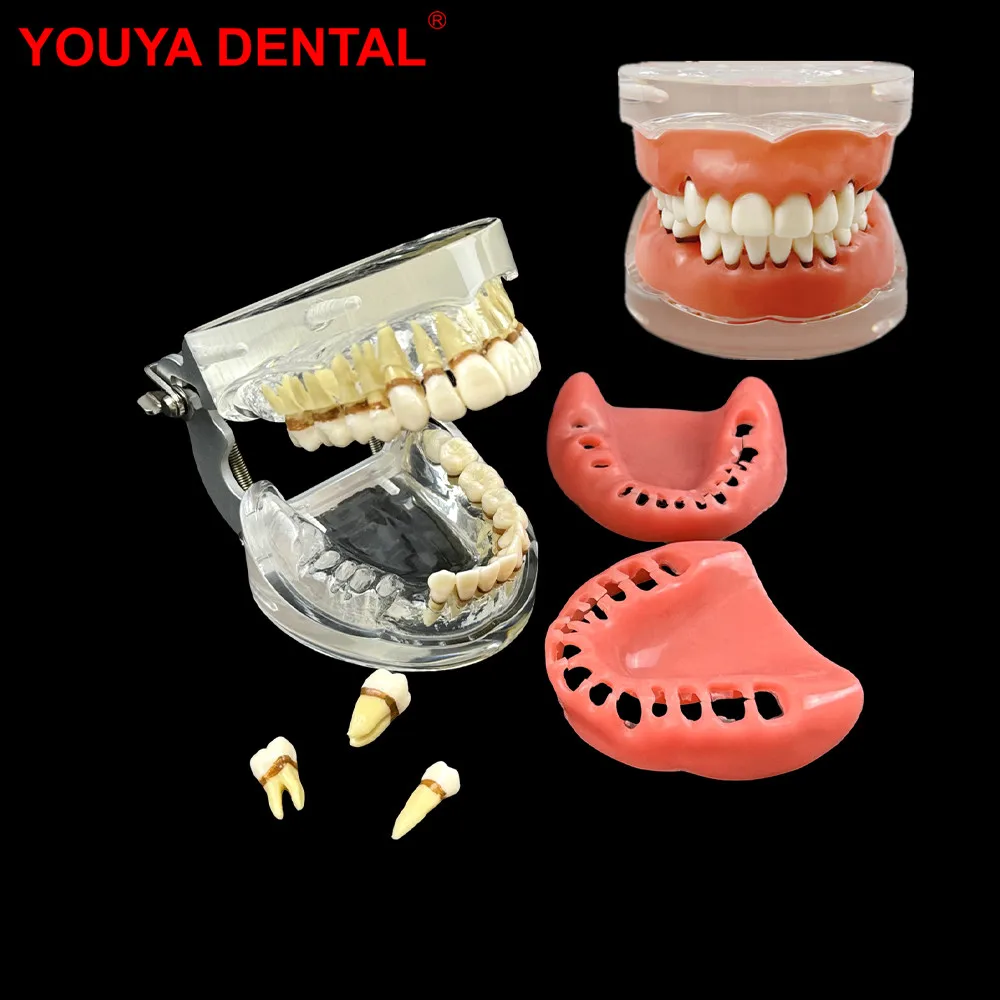 Periodontal Disease Model Dental Teeth Model Dentist Student Model Soft Gums Removable Tooth Typodont For Patient Education Demo