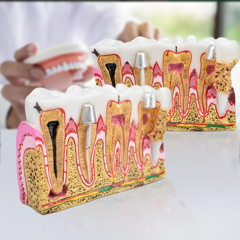 

Dental Caries Anatomy Comprehensive Pathology Tooth Nerve Tooth Model for Oral Teaching Teeth Model