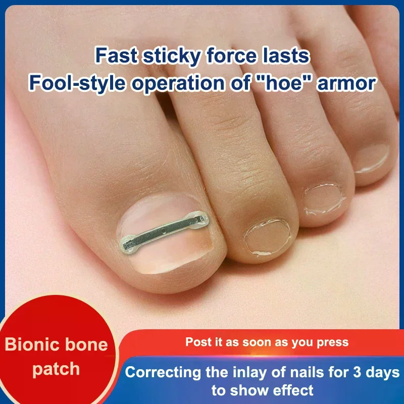 10個入り陥入爪治療キット、4つのマルチサイズ、チタン合金陥入爪矯正ツール、湾曲した爪矯正用