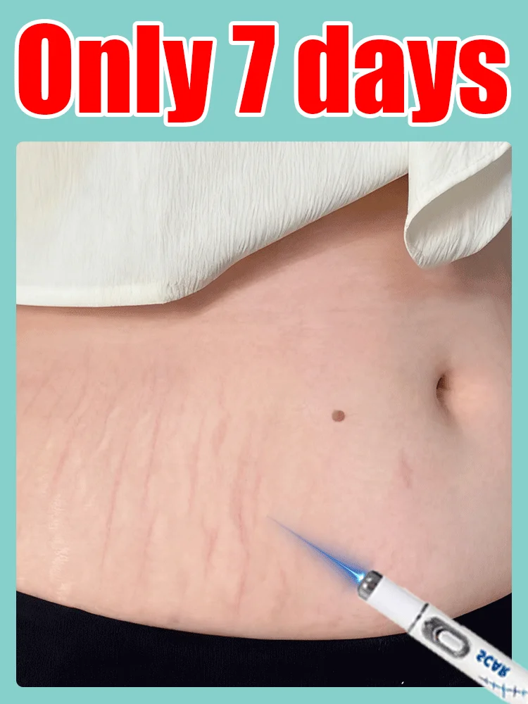 أحدث ليزر من الجيل الثاني لعلامات التمدد، المزيد من الخصومات على العبوات #1