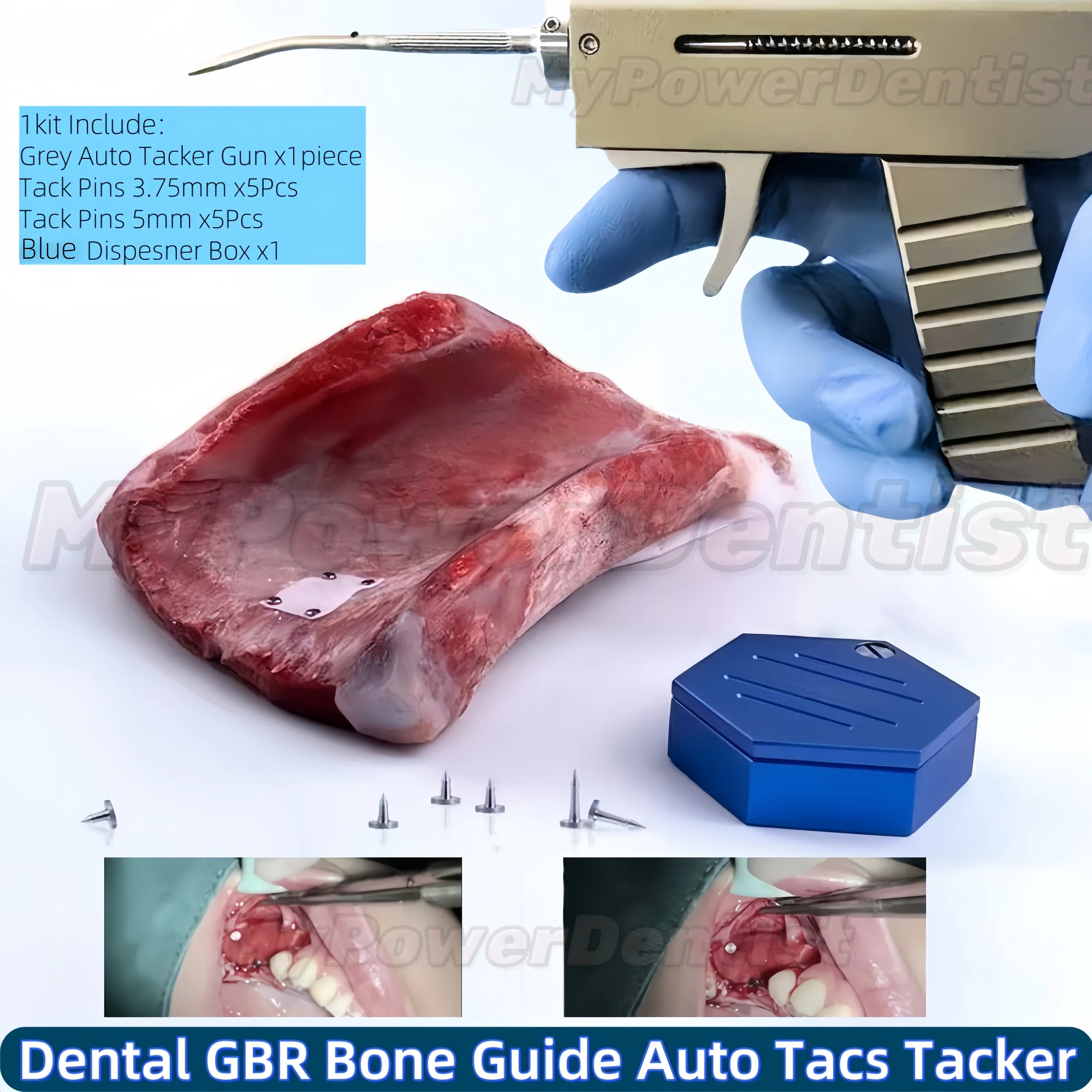 

Стоматологические GBR Bone TAC титановые штифты, мембранная направляющая для пистолета, комплект автоматической таблоки, 12 шт.