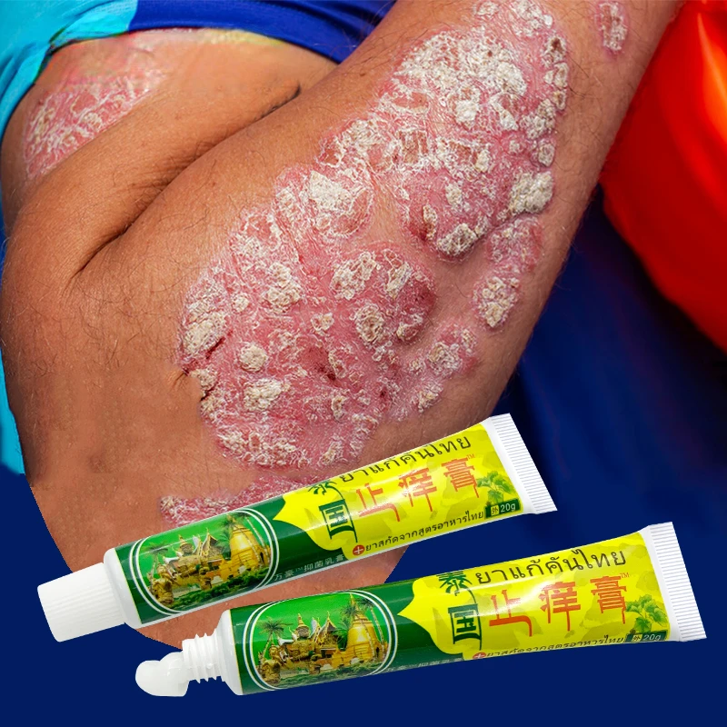 Psoriasis Removal Cream Treat Psoriasis Eczema Dermatitis Ointment Skin Allergies Cool Relief Itch Inhibit Skin Body Health Care