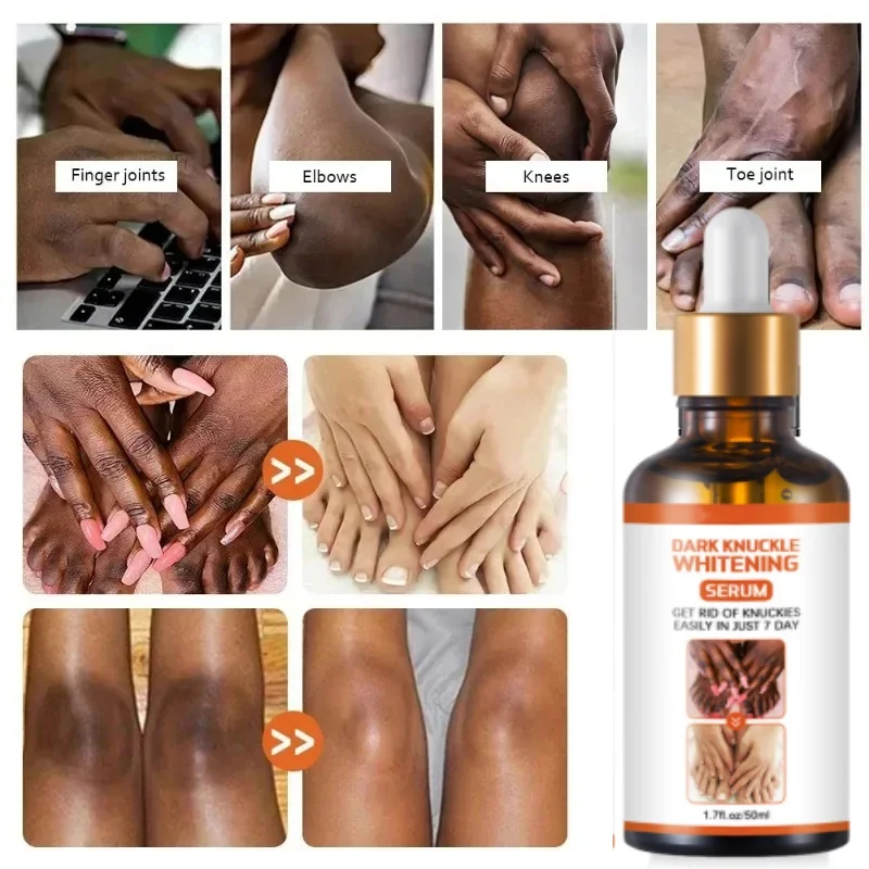 Black Skin Remover Essence Elbows Hand Dark Knuckle Fast Brightening Serum Lightening Glow Recipe Skincare Body Safety  Products