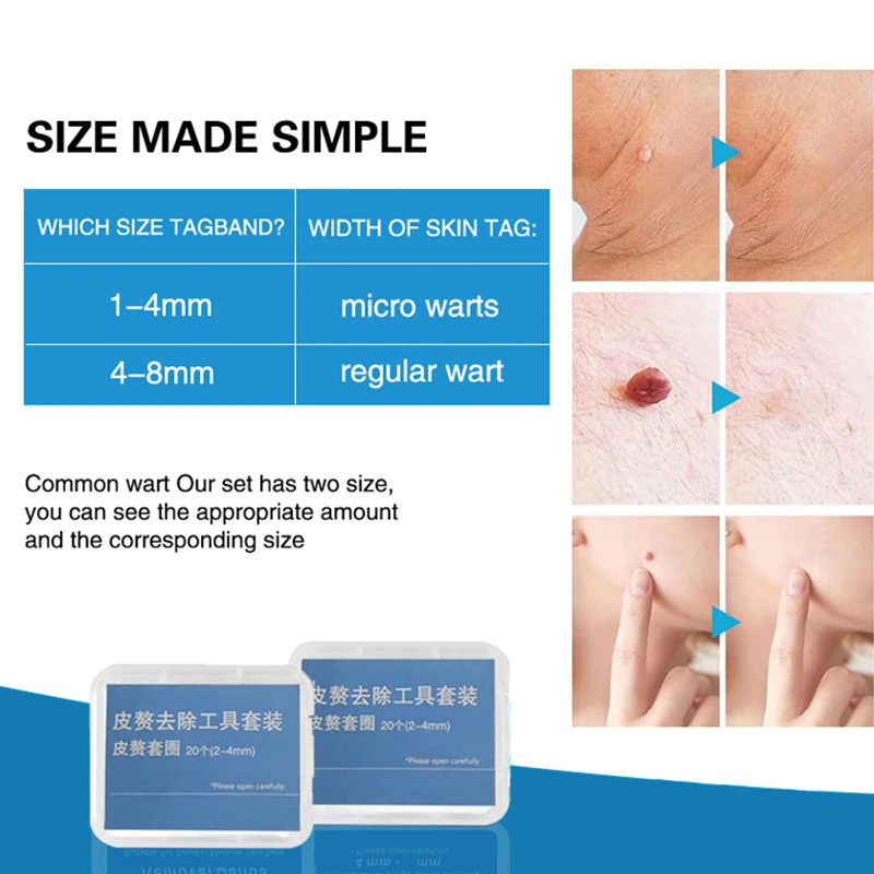 20pcs/Box Flesh Nevus Removal Bands Non-Toxic Mole Rubber Kit Wart Treat Tool Men Women Face Skin Care No Pain Safe view 4