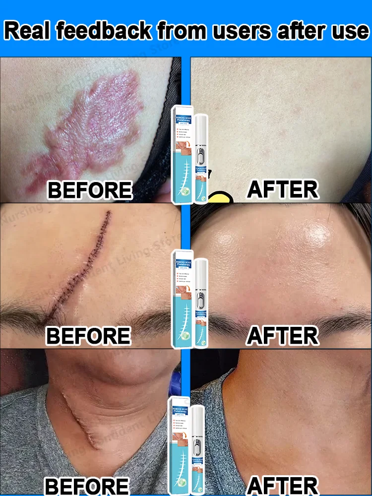 Laser scar repair