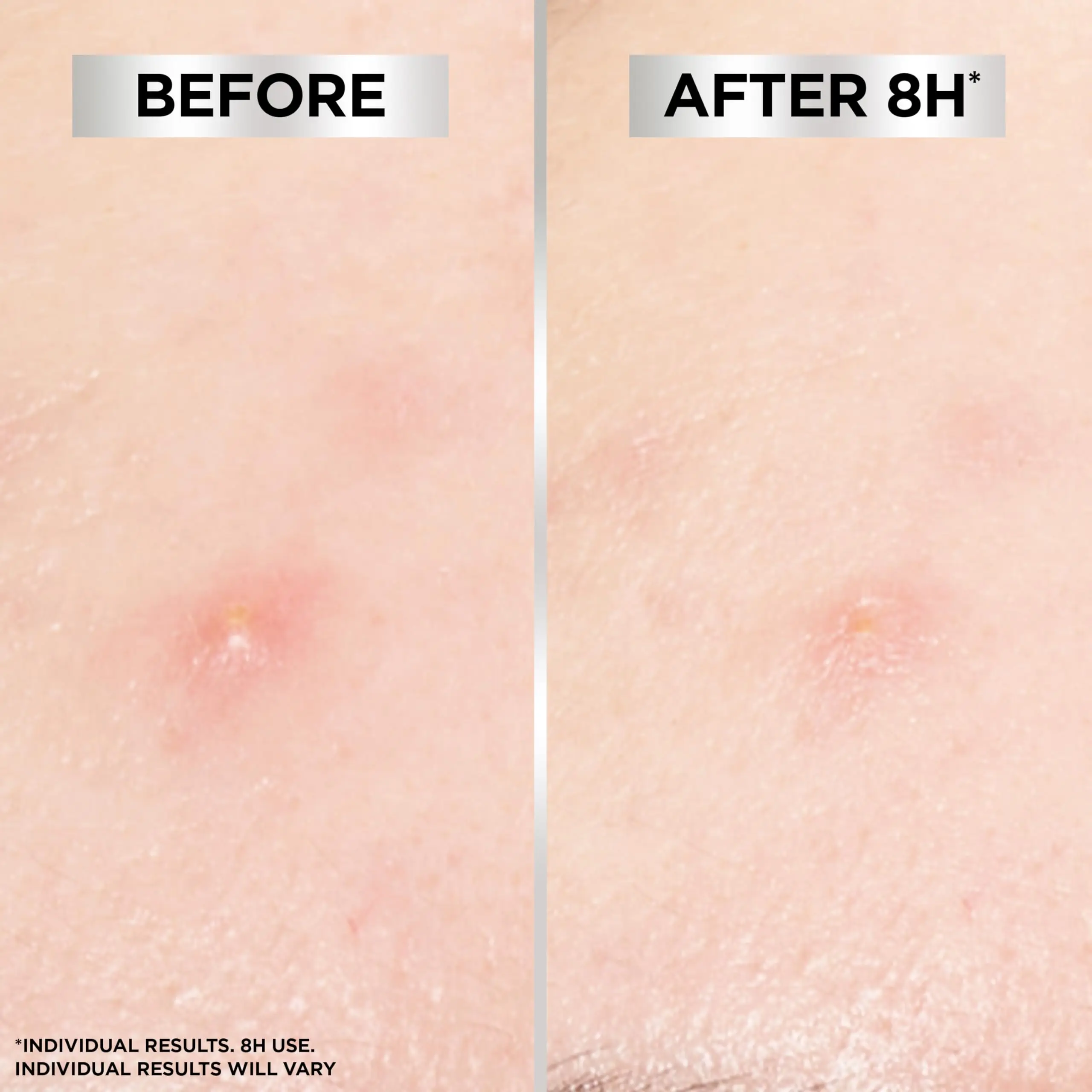 1080 قطعة/720 قطعة/360 قطعة مجموعة رقعة خافي عيوب حب الشباب تنظيف خفيف وغير مزعجة لمسام الوجه رعاية قناع حب الشباب