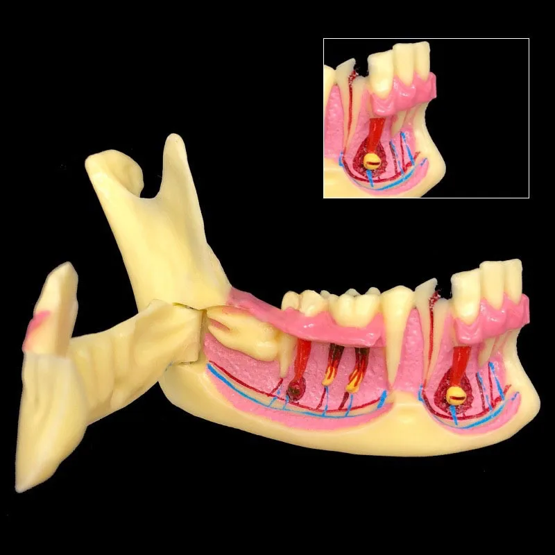 Mandibular Decomposing Model Lower Gingival Side Can Open Demonstration Anatomical Model Teaching Model