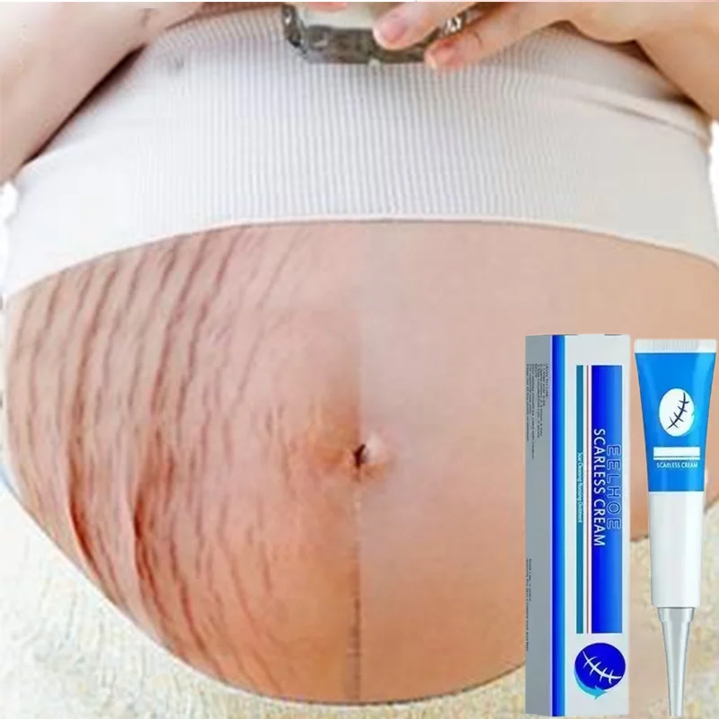 Eliminate Red White Old Stretch Marks Cream For Pregnancy Postpartum Skin Care Gel