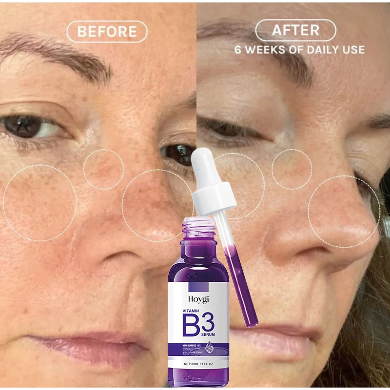 30ml niacinamida 10% suero Facial vitamina B3 suero hidratante de resorte térmico para reafirmar arrugas blanqueamiento brillo cuidado de la piel