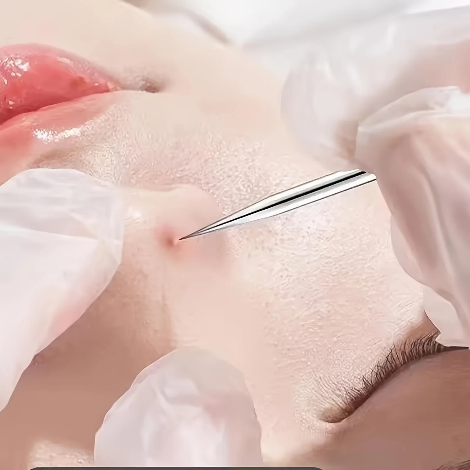 Ensemble d'aiguilles 8 pièces, pince cellulaire, élimination des points noirs, pincettes Ultra-fines, Salon de beauté professionnel, aiguille de haute précision