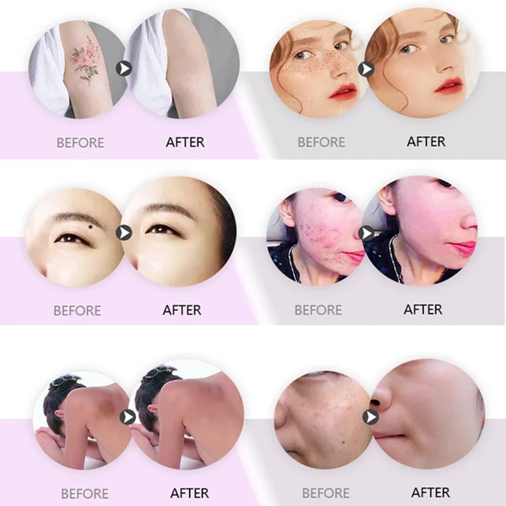 HaoBeauty YAGlaser المحمولة بيكو ثانية مزيل النمش بالليزر الوشم استشعار الضوء غير الغازية الحاجب غسالة