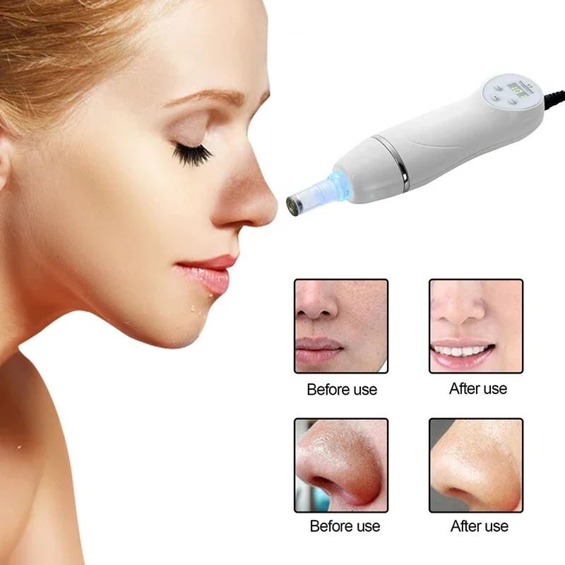 

Home use portable tool kit pore vacuum suction diamond dermabrasion blackhead remover