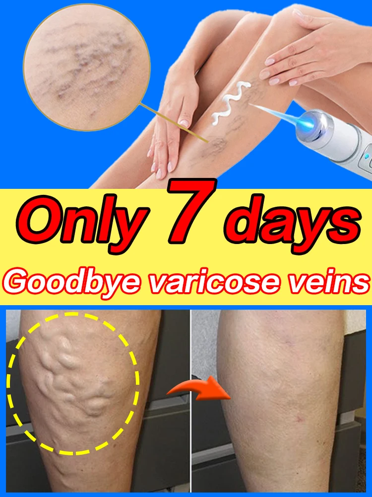 Varicose Veins Blue Light Pen Laser