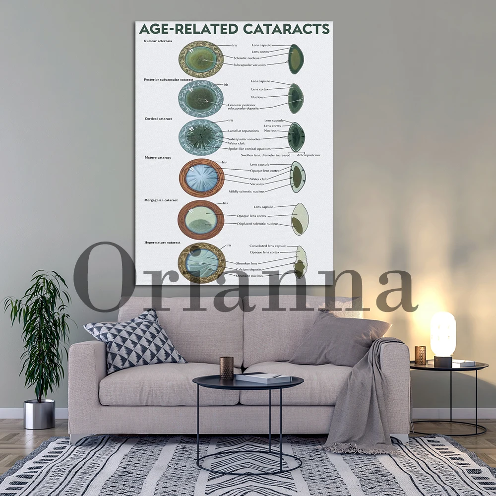 Eye Related Poster Cataract Awareness Wall Art Eye Health Decor Eye Disease Anatomical Chart Art Print Retro Canvas Painting