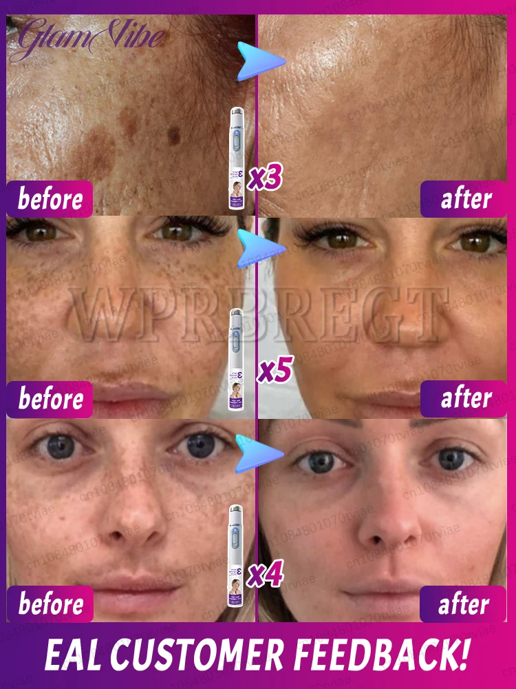 〔Hot sale〕Effectively solve the problem of ᴘɪɢᴍᴇɴᴛ ᴀᴄᴄᴜᴍᴜʟᴀᴛɪᴏɴ and say goodbye to pigmentation