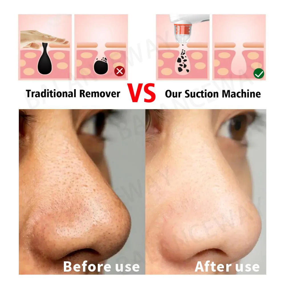 2023 Đầu Đen Tẩy Thị Giác Pore Cleaner Rửa Mặt Đen Chấm Bi Tẩy Tế Bào Chết Làm Đẹp Khuôn Mặt Chăm Sóc Da Công Cụ Cây Đẩy Mụn Tẩy Trang