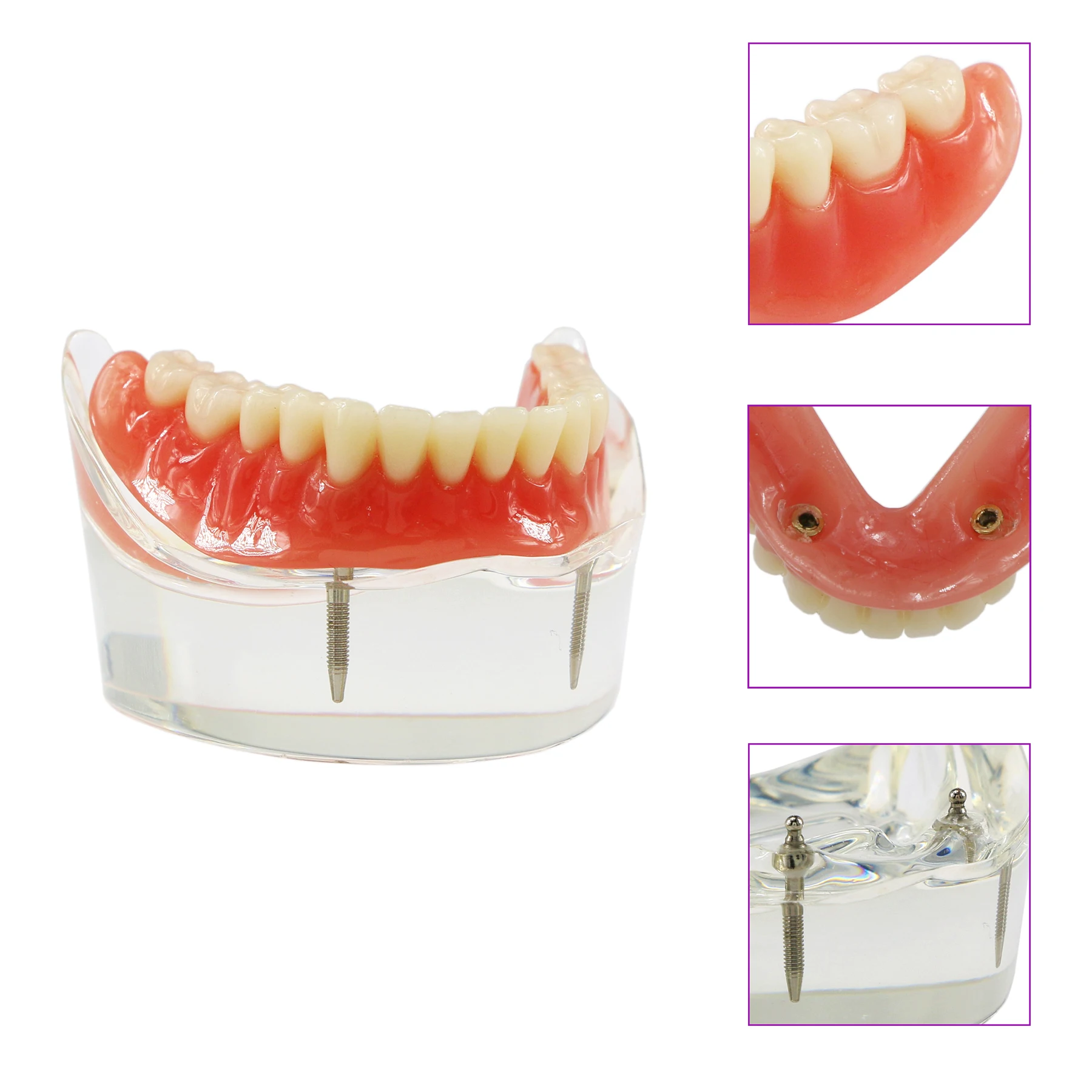 Dental Model M6002 Overdenture Inferior 2 Implants Restroration Study base allows view of implants