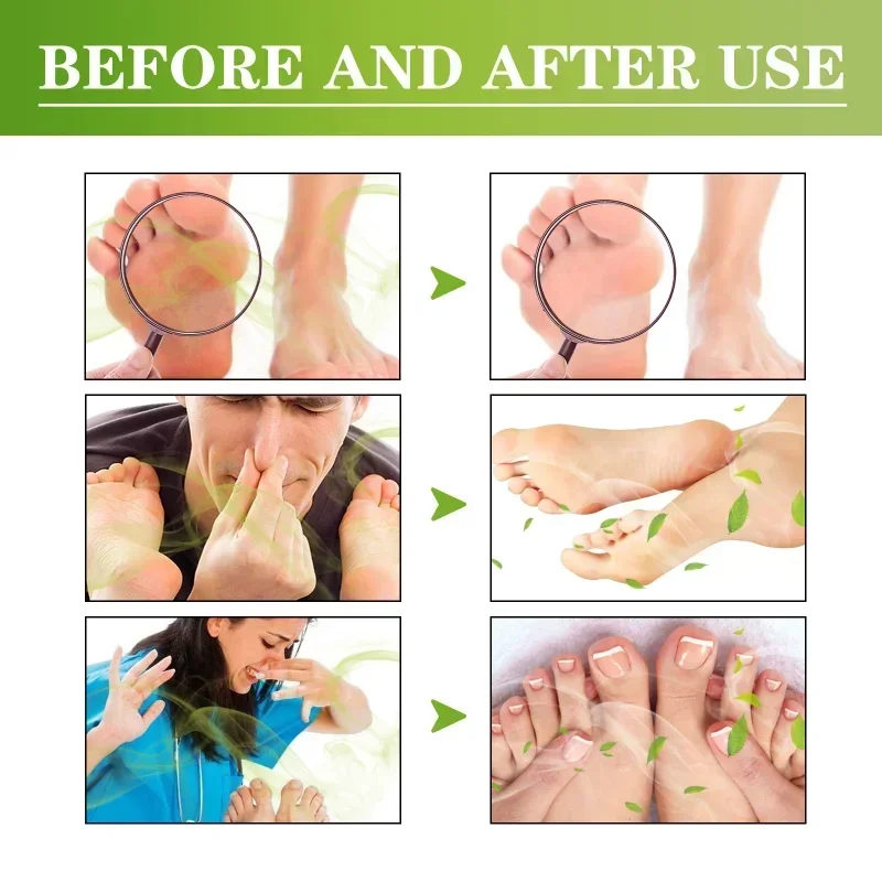 Sdotter New Athletes Foot spray Beriberi Cream Deodorant remove Odor Dry Crack peeling Anti itch sweat feet moisturizing skin fr