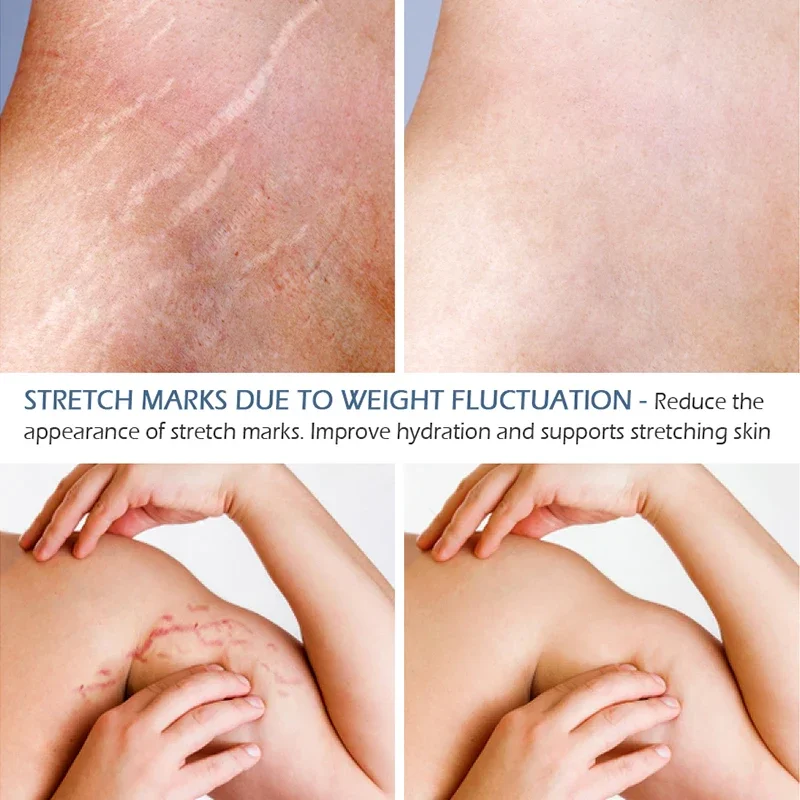 Stretch Marks Permanent Removal Serum Effective Treatment Stretch Marks Burn Surgical Scars Anti-Aging Firming Smooth Body Care