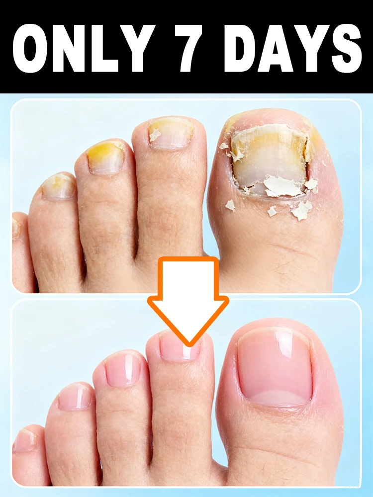 

ᴾʳᵉᵛᵉⁿᵗ ᵗʰᵉ ˢᵖʳᵉᵃᵈ ᵒᶠ ᵒⁿʸᶜʰᵒᵐʸᶜᵒˢⁱˢ ᵃⁿᵈ induce tinea pedis and subungual abscess