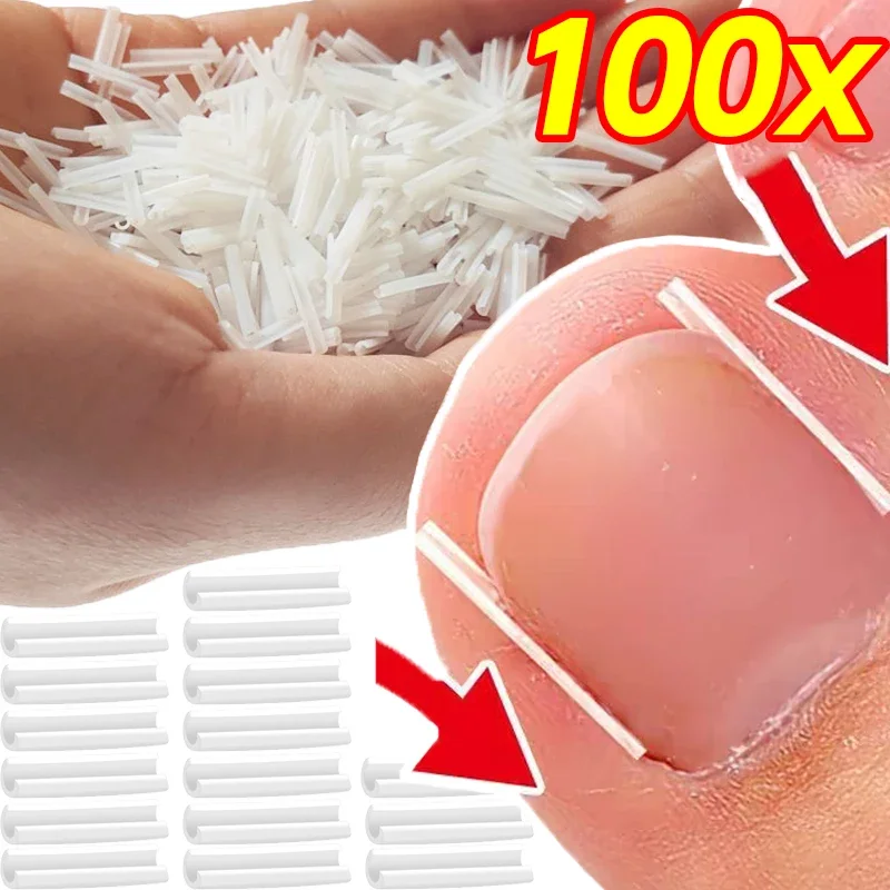 1/20 kutu Görünmez Batık Ayak Tırnak Tedavisi Pedi Batık Ayak Tırnağı Düzeltme Aracı Oluk Doğrultma Klip Brace Ayak Bakımı