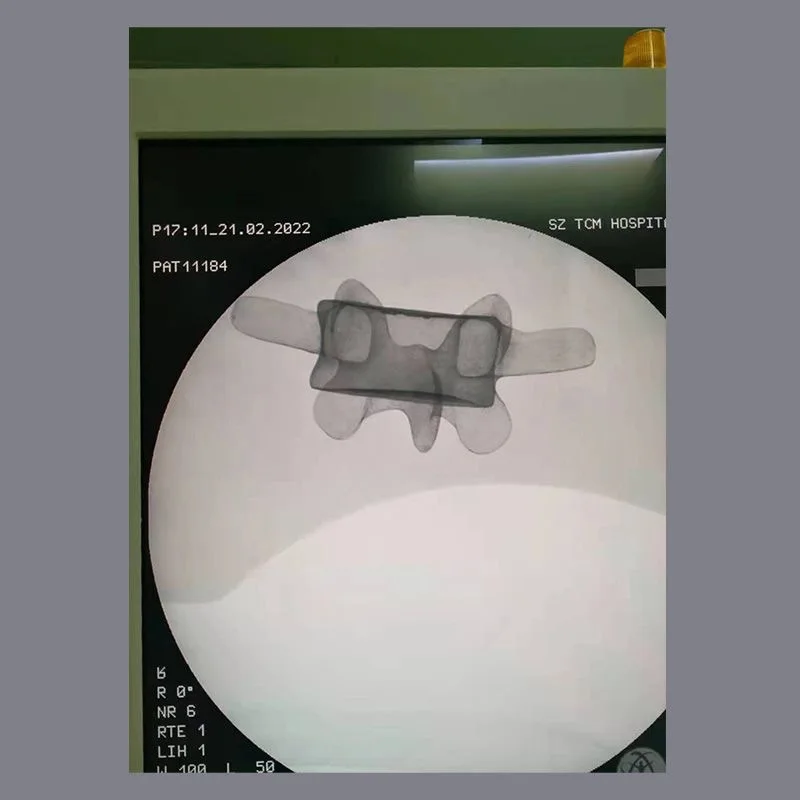 Sawbones Solid Foam Human Lumbar 1 ถึง Sacrum Lumbar Spinal Model พร้อมรากเส้นประสาทสําหรับศัลยกรรมกระดูก