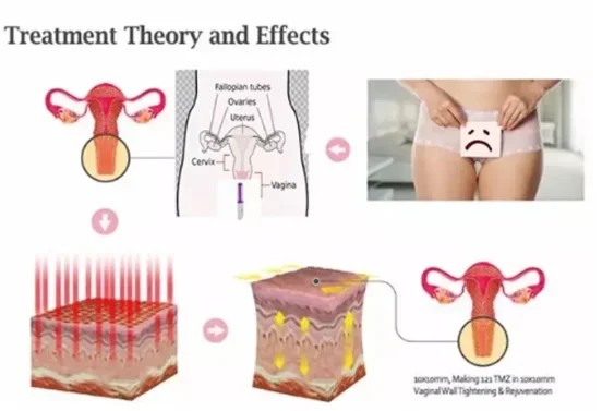 

Laser Treatment Instrument Gynecological Disease Pelvic Infection Vaginal Tightening Physical Soft Laser Therapy Device