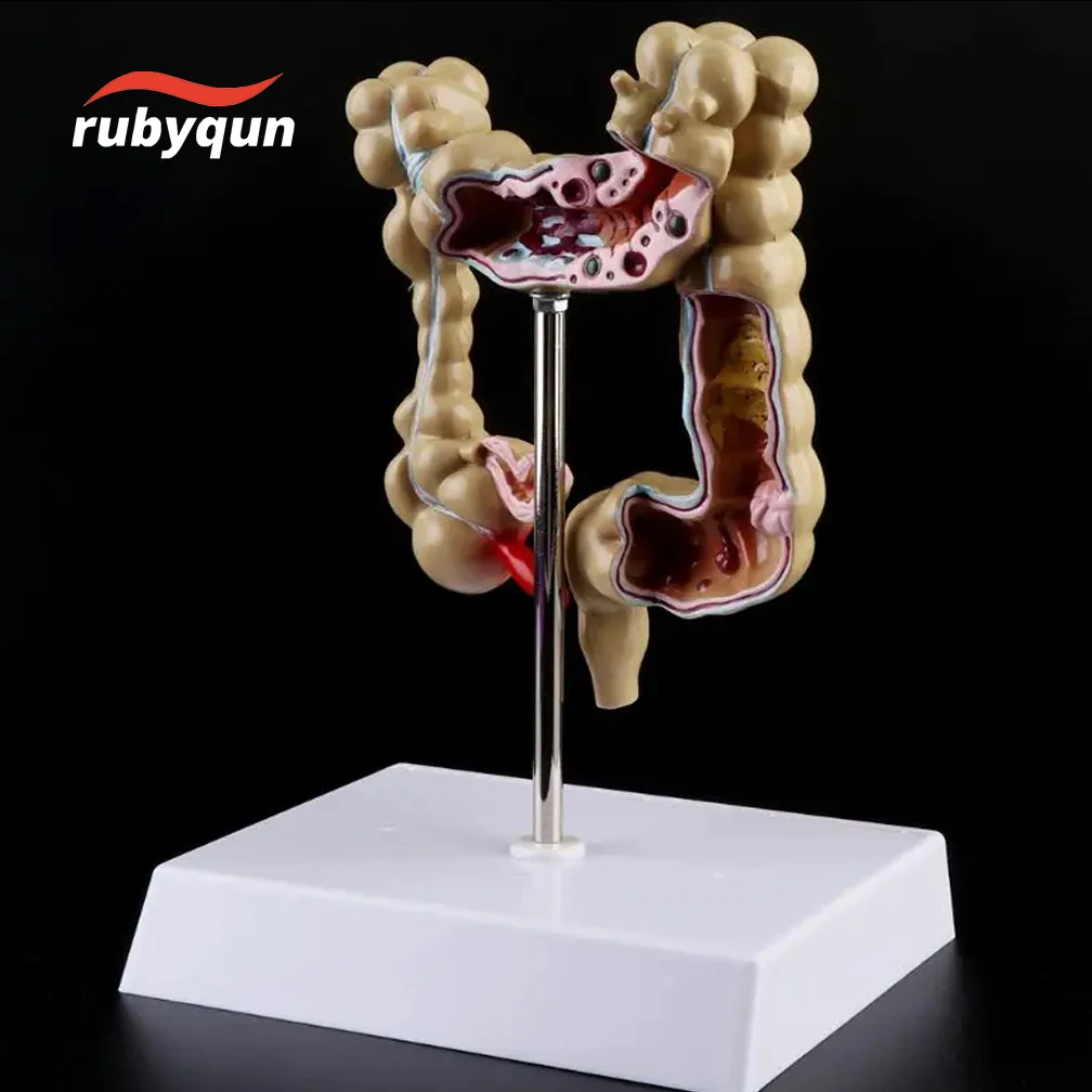 

Colon Model Human Body Anatomy Replica of Colon Common Pathologies for Doctors Office Educational Tool Study﻿ Training Set