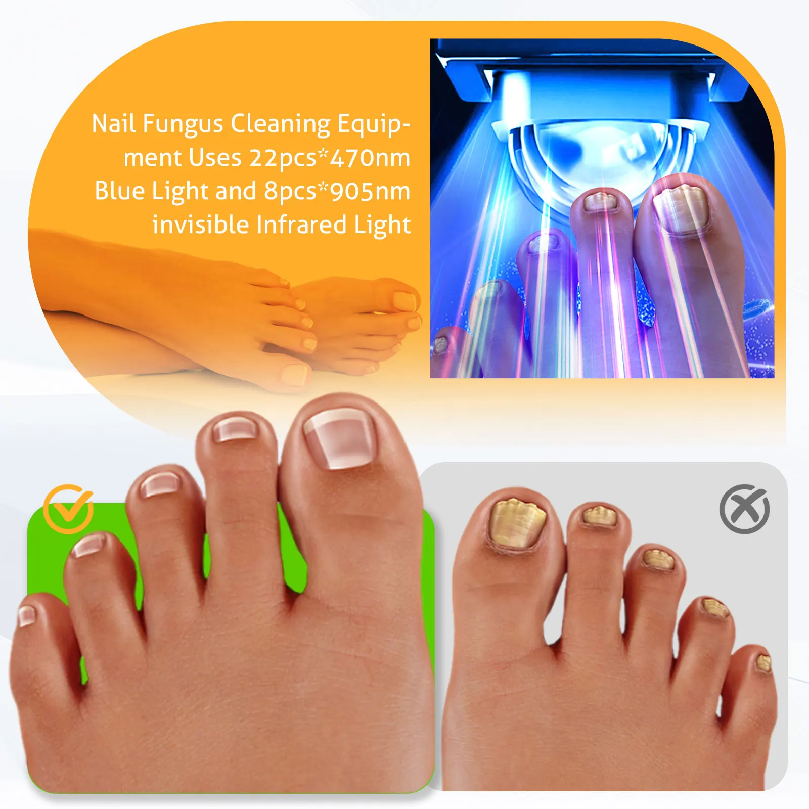 New Nail Fungus Laser Treatment Device 470nm Blue Light 905nm Invisible Infrared Light Dual-Wave Therapy for Onychomycosis - view 4
