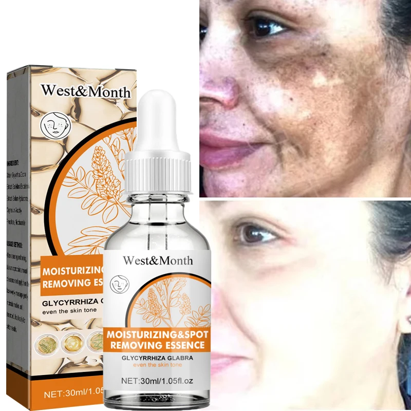 Dark Spot Corrector Face Serum Remove Melasma Chloasma Senile Plaques Whitening Repair Cream Lightening Freckle Korean Cosmetics